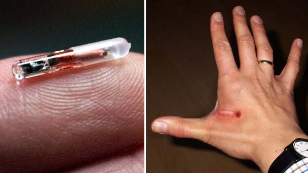 microchip sottocutanei